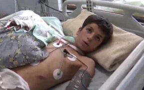 یک جراحی کم‌نظیر در بروجرد؛ دست قطع‌شده نوجوان دوباره به بدن بازگشت